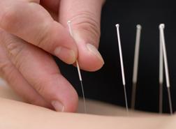 Acupuncture